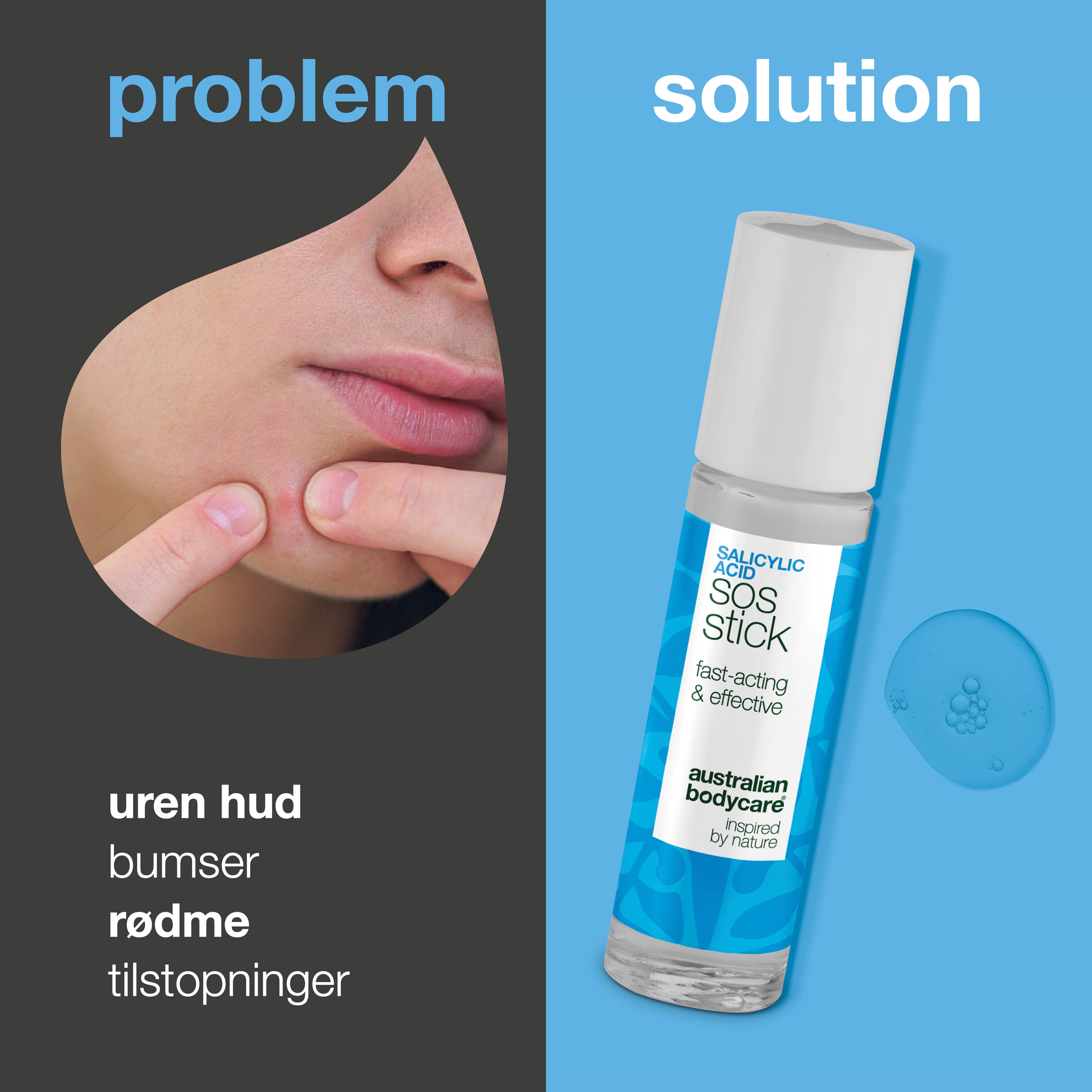 Salicylsyre SOS Stick mod bumser, rødme og tilstopninger — Salicylsyre SOS Stick mod urenheder og fedtet hud. Beroliger, renser og forebygger udbrud. Indeholder Salicylsyre.