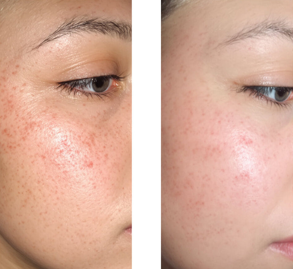 Serum mod bumser, hudorme og uren hud – Salicylsyre 2 % — Serum mod bumser og fedtet hud. Renser porer og dæmper udbrud. Med salicylsyre 2 %, Zinc PCA, grøn te og hyaluronsyre.