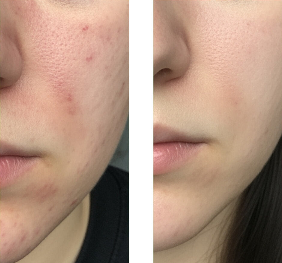 Salicylsyre Ansigtsrens mod bumser og hudorme — Salicylsyre Cleanser opløser talg, forebygger uren hud og giver frisk glød.