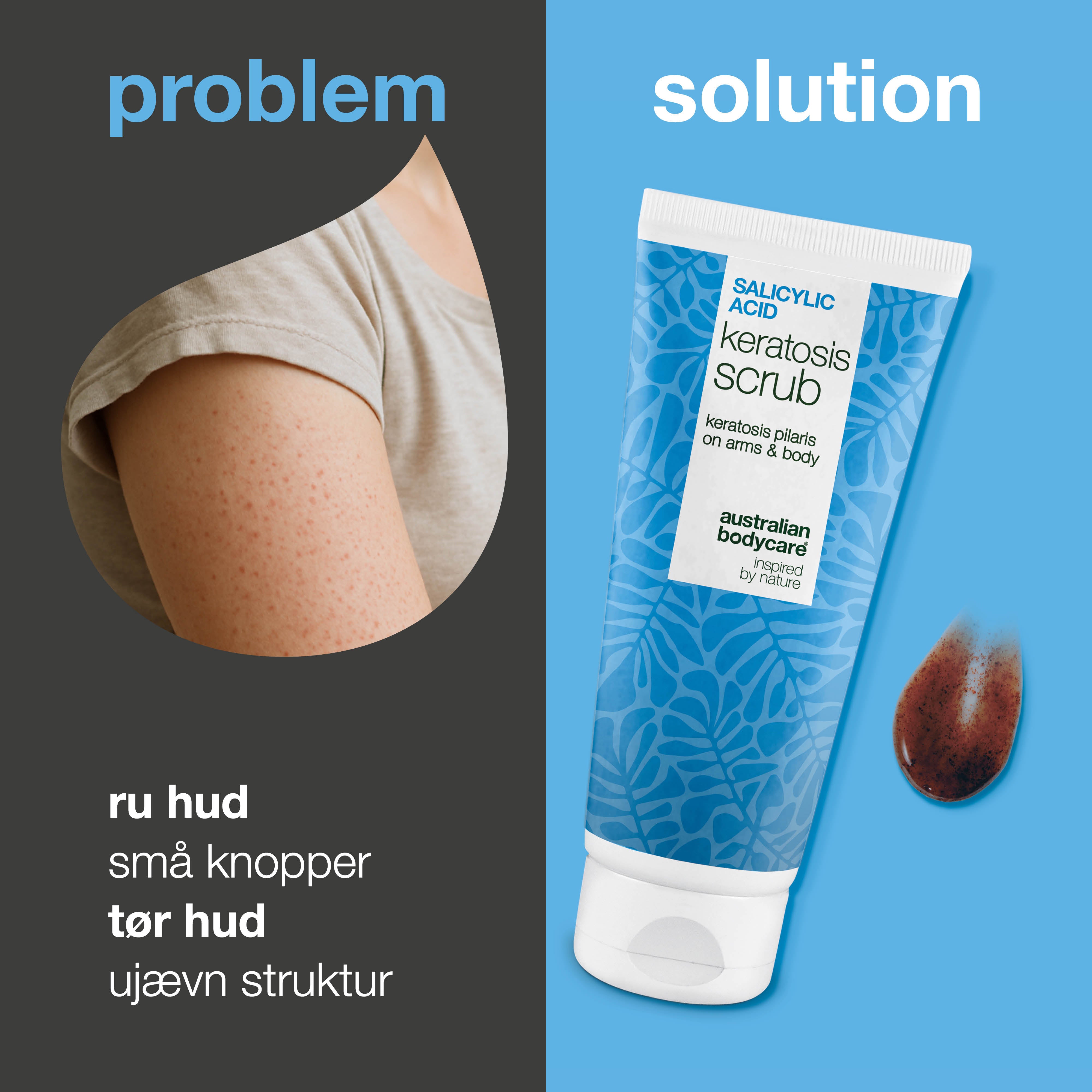 Keratosis Pilaris Body Scrub mod ru hud og knopper — Keratosis Pilaris Body Scrub mod ru hud og knopper. Eksfolierer og blødgør med salicylsyre, glykolsyre og glycerin.